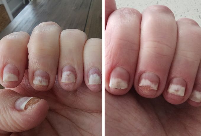 Gel Nail Polish Allergy On Nails