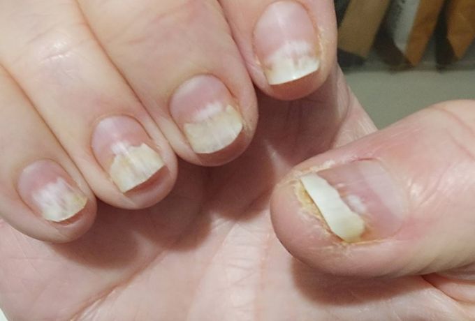 Gel Nail Polish Allergy