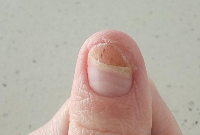 What Is a Gel Nail Polish Allergy?